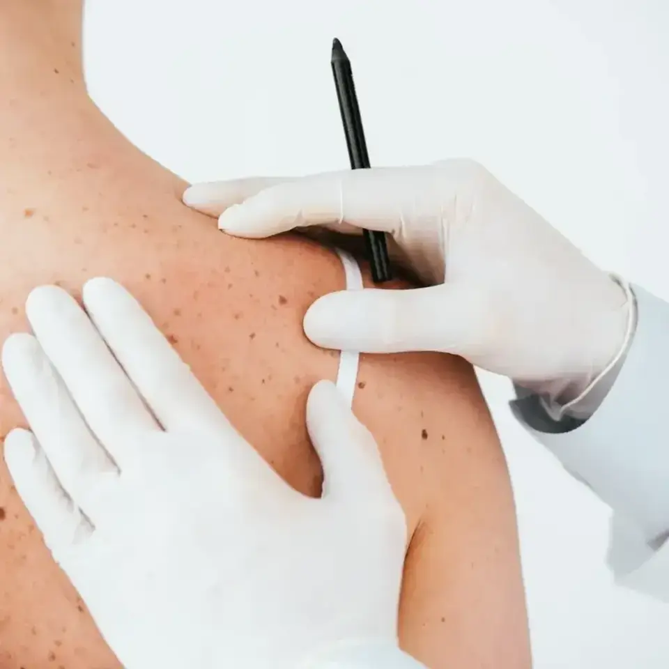 Consulta de dermatologia clínica - tratamento de acne, rosácea e manchas na pele